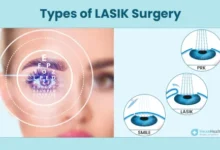 how much is laser eye surgery