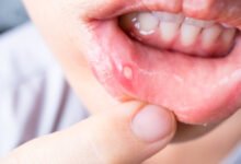 How to Get Rid of a Canker Sore in 24 Hours