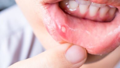 How to Get Rid of a Canker Sore in 24 Hours