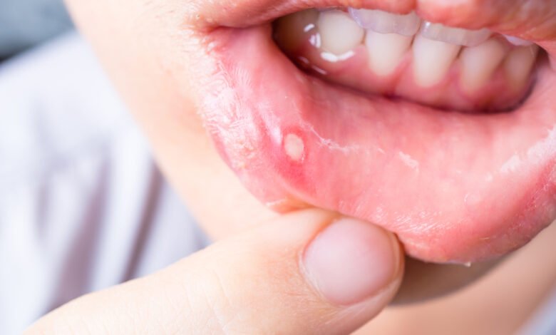How to Get Rid of a Canker Sore in 24 Hours