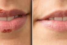 How to get rid of a cold sore in 24 hours