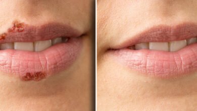 How to get rid of a cold sore in 24 hours