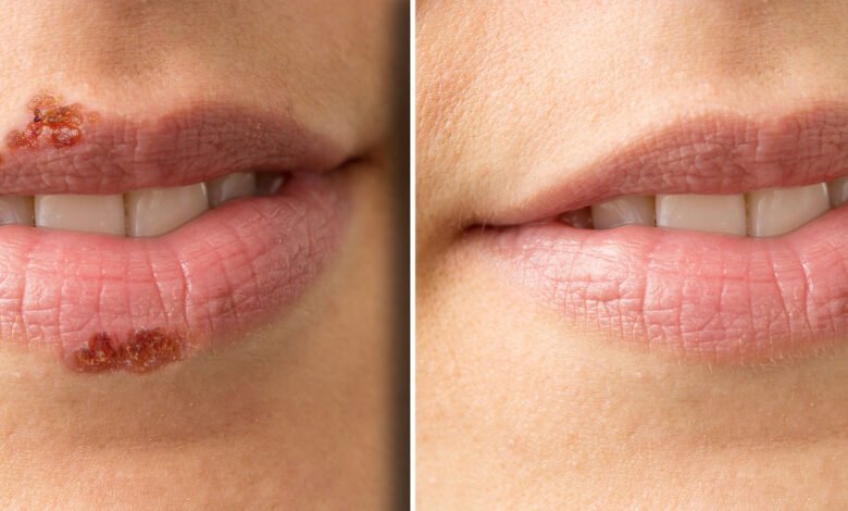 How to get rid of a cold sore in 24 hours