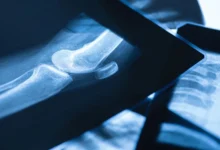 What Is the Broken Bone Theory
