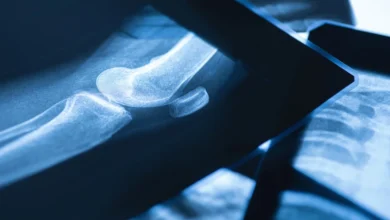 What Is the Broken Bone Theory