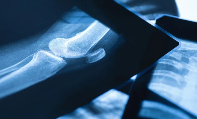 What Is the Broken Bone Theory