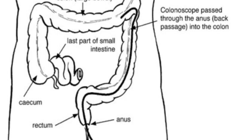 How long will i be on the toilet for colonoscopy prep
