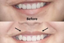 Lip Flip Before and After