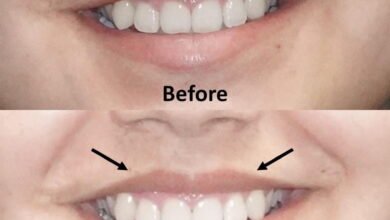 Lip Flip Before and After