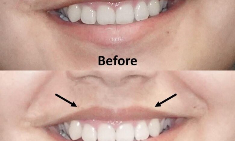 Lip Flip Before and After